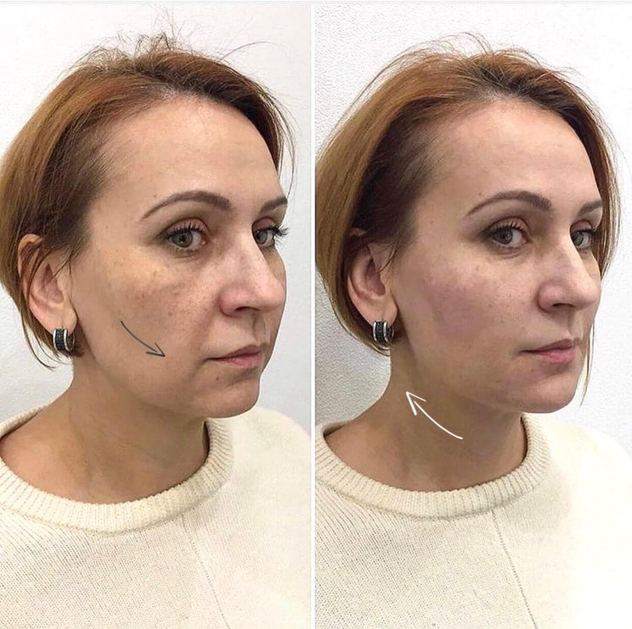 Стан шкіри клієнтки до того як вона звернулась до косметологічної клініки Beauty Zone