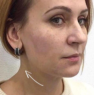 Стан шкіри клієнтки пілся того як вона звернулась до косметологічної клініки Beauty Zone